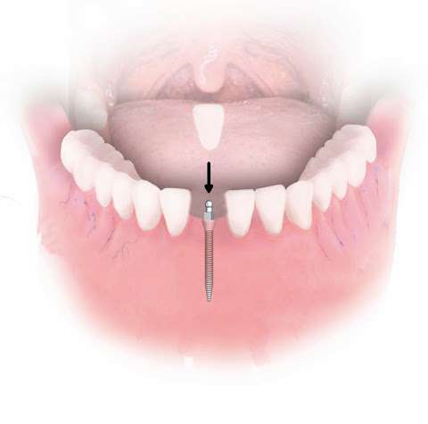 Errick L. Cameron, DMD Mini Dental Implants